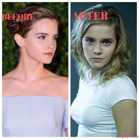 did emma watson get a boob job|Emma Watson, Before and After .